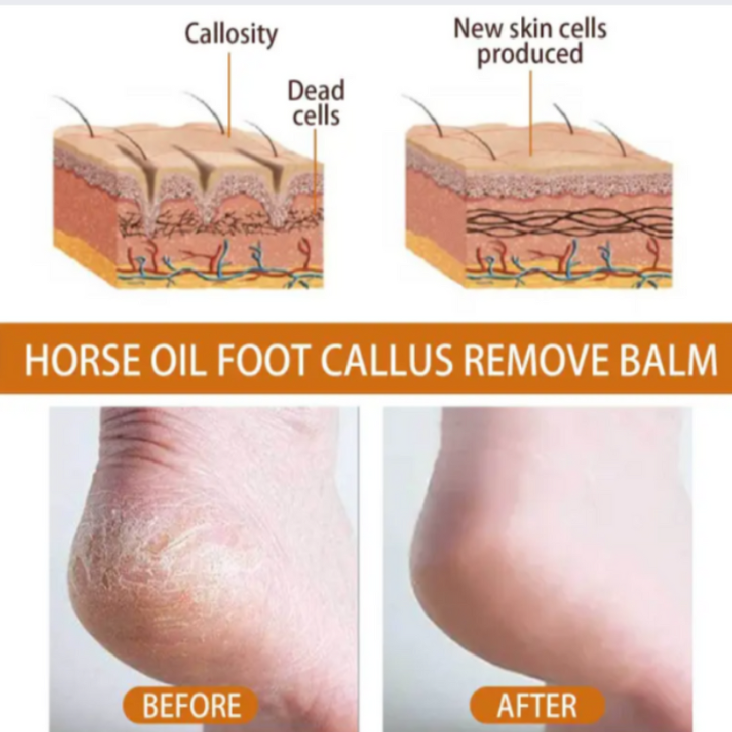 TrueTouch™ Callous Remover